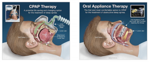 CPAP therapy versus oral appliance diagram