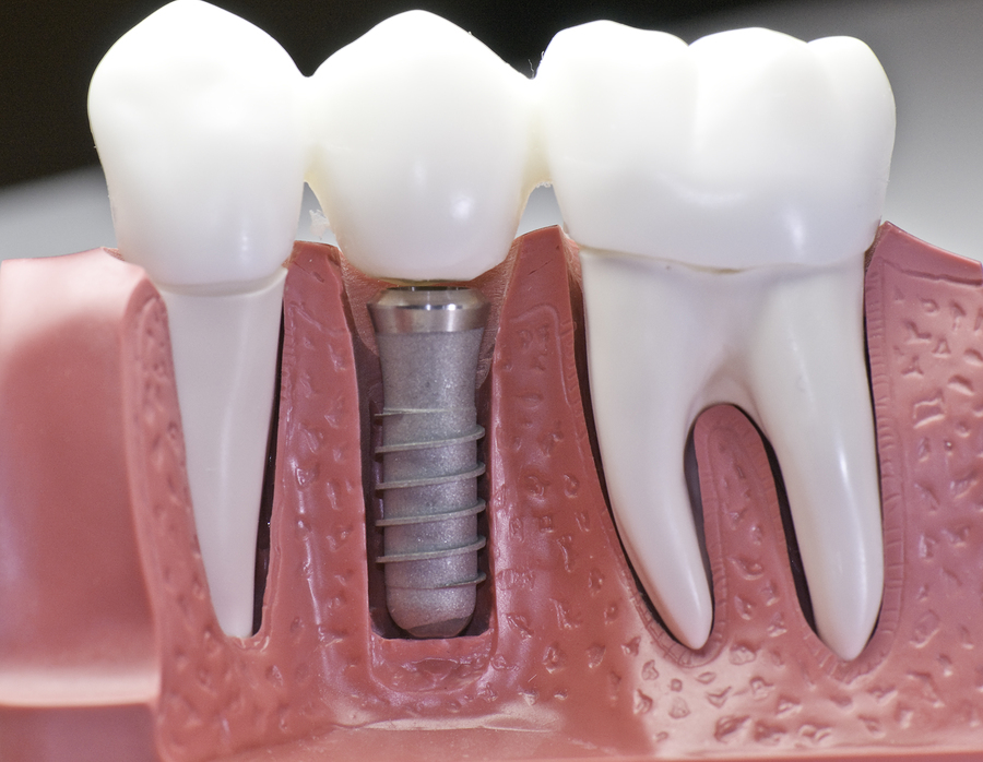 model of dental implant surrounded by two natural teeth