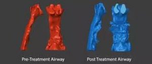 model comparing an airway before and after treatment