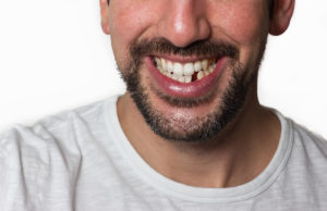 adult male with a missing tooth smiling