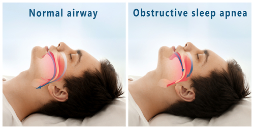 diagram of normal airway vs obstructed airway